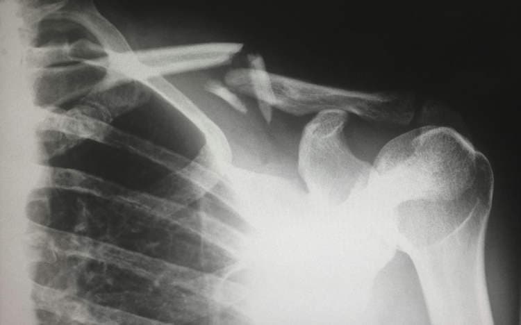 Thumbnail for Sunscreen Overload Snaps 48-Year-Old’s Bones in Chengdu Hospital Bed