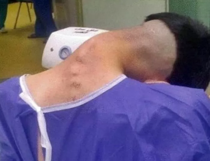 Thumbnail for Doctors Stunned as Dropped Head Syndrome Leaves Man Staring at His Own Shoes