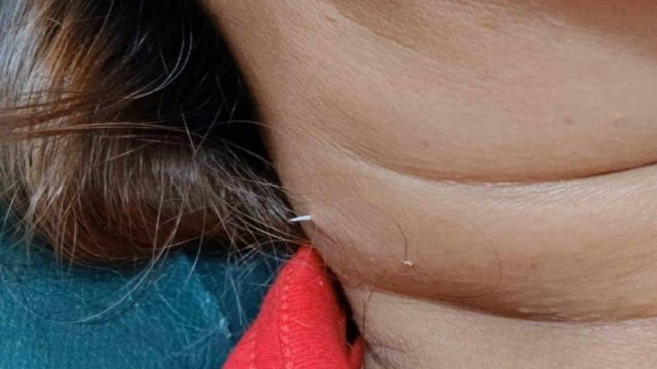 Thumbnail for Thai Woman's Fish Bone Ordeal: Neck Pierced from Within