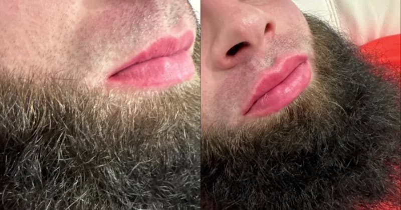 Thumbnail for Dagestani Men Embrace Lip Fillers Amid Midnight Beauty Boom