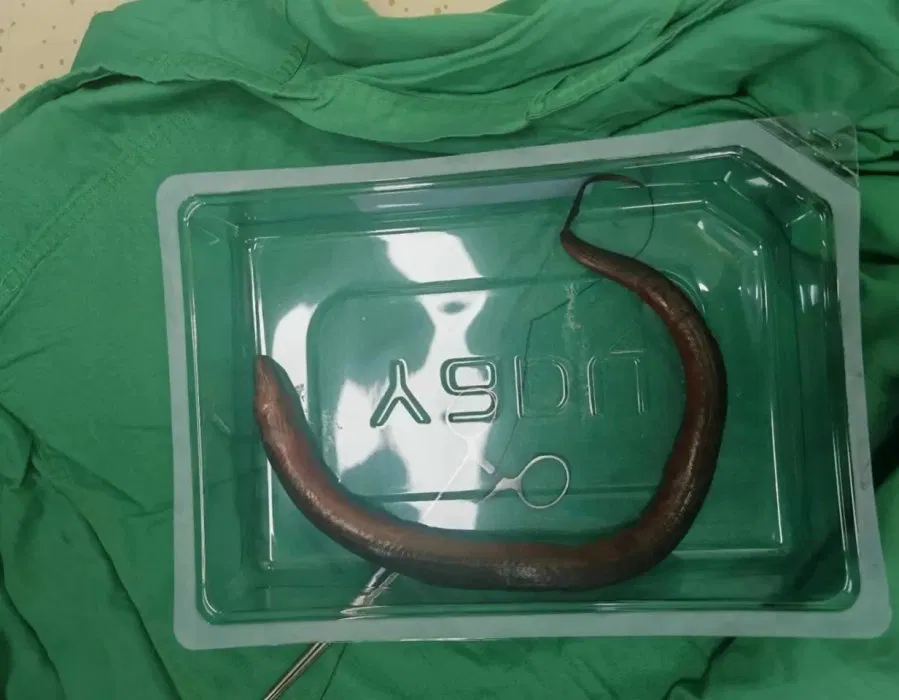 Thumbnail for Hunan Hospital Surgeons Extract 12-Inch Eel Swimming Inside Patient’s Abdomen