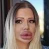 Thumbnail for World's Biggest Lips: Sofia Woman's $25K Pout Blocks Tooth Rescue