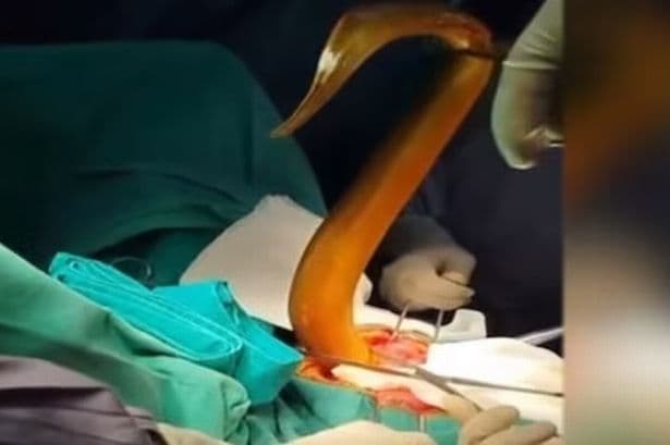 65 cm live eel eats through bowel during hospital emergency