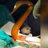 65 cm live eel eats through bowel during hospital emergency